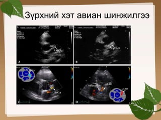 Зүрхний хэт авиан шинжилгээ 
 