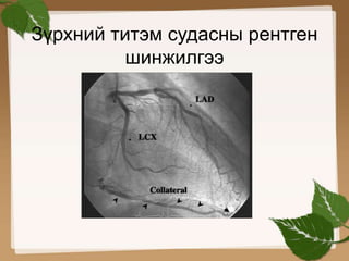 Зүрхний титэм судасны рентген 
шинжилгээ 
 