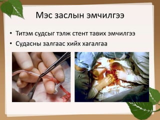 Мэс заслын эмчилгээ 
• Титэм судсыг тэлж стент тавих эмчилгээ 
• Судасны залгаас хийх хагалгаа 
 