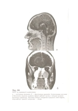 Нервові хвороби. Віничук С. М.,  2001.к-сть сторінок-397