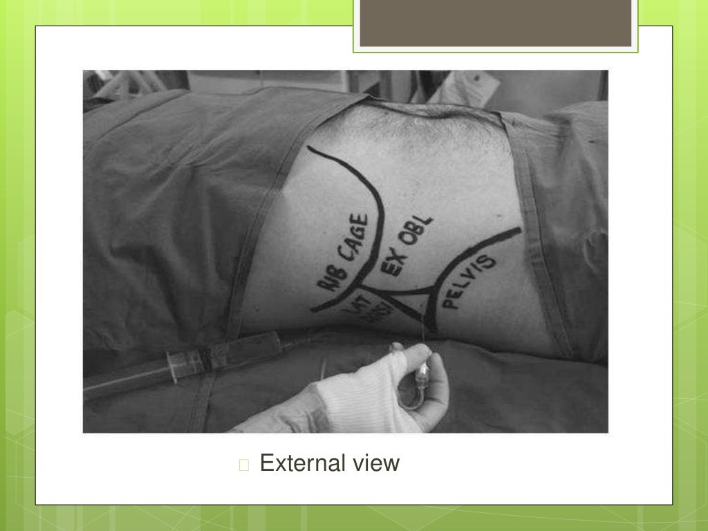 Lumbar triangle(Petit’s triangle) and it’s anatomical characteristics