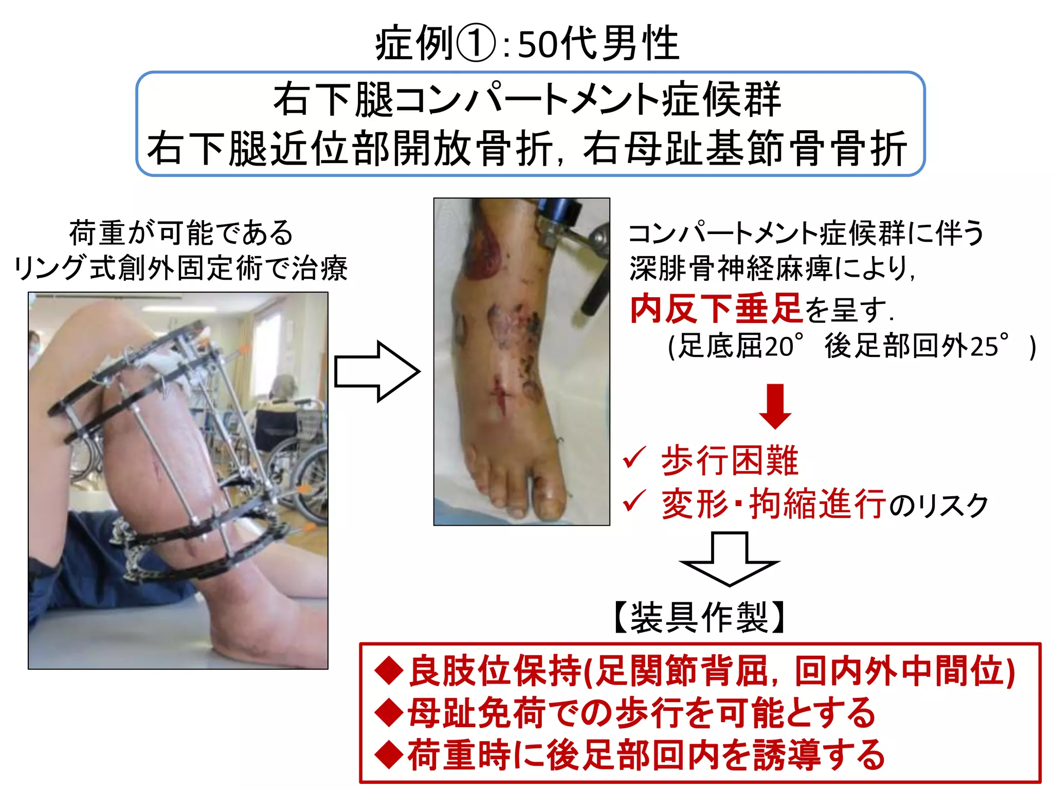 本 スタンダード 骨折手術治療 下肢