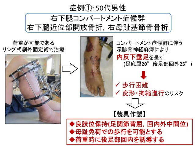 下肢創外固定術後装具療法の試み | PPTX | Bone and Joint Conditions | Diseases and ...