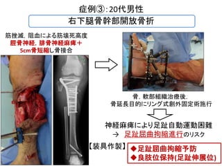 下肢創外固定術後装具療法の試み 下肢創外固定術後装具療法の試み