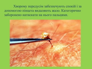 Хворому передусім забезпечують спокій і за 
допомогою пінцета видаляють жало. Категорично 
заборонено натискати на нього пальцями. 
 