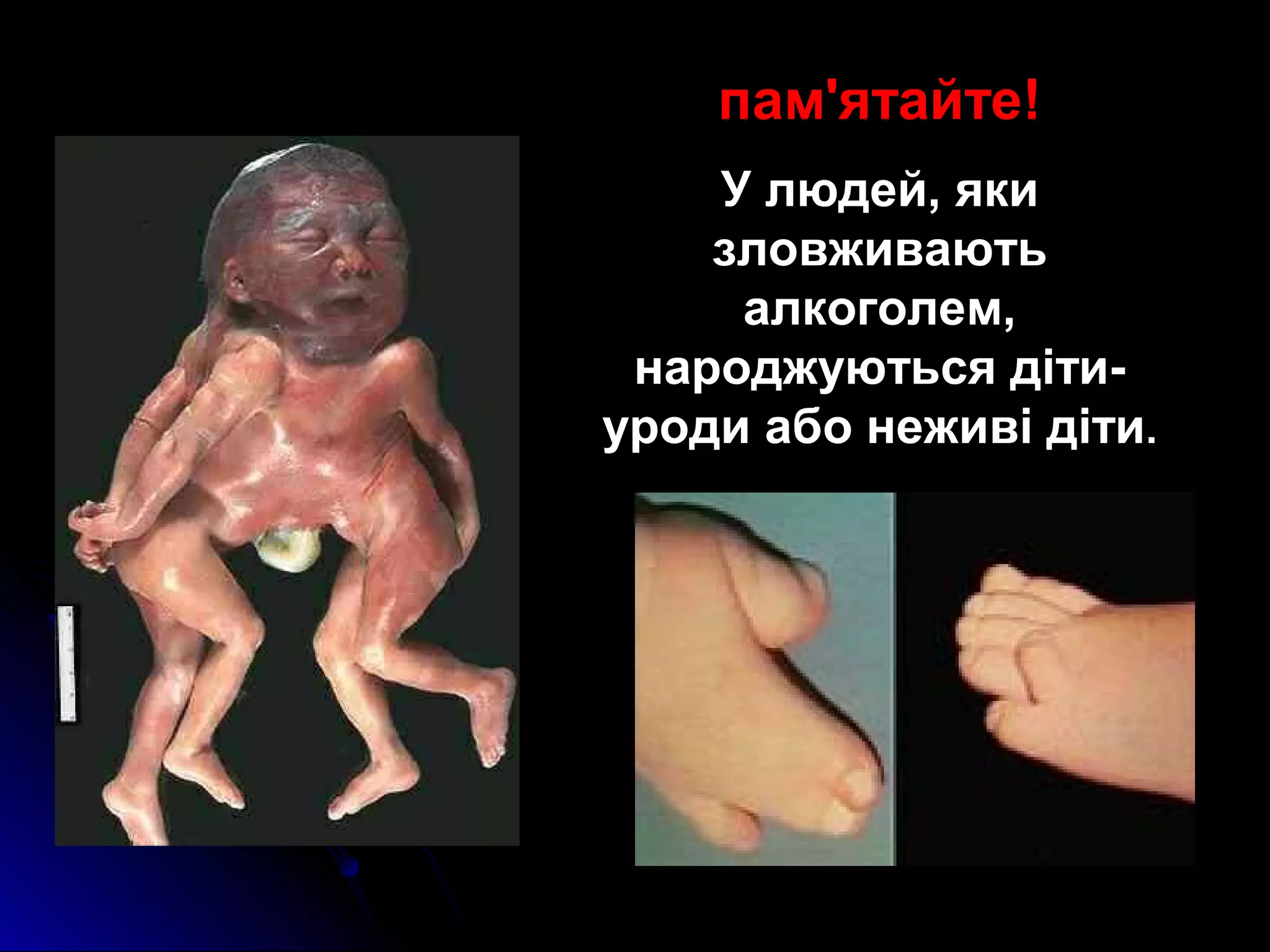 пам'ятайте! 
У людей, яки 
зловживають 
алкоголем, 
народжуються діти- 
уроди або неживі діти. 
 