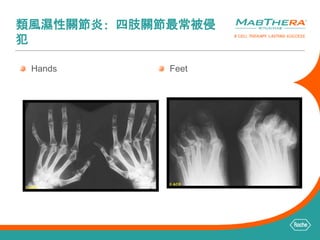 類風濕性關節炎: 四肢關節最常被侵 
犯 
Feet 
Hands 
 