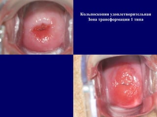 Кольпоскопия удовлетворительная
Зона трансформации 1 типа
 