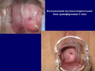 Кольпоскопия неудовлетворительная
Зона трансформации 3 типа
 