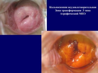 Кольпоскопия неудовлетворительная
Зона трансформации 3 типа
Атрофический МПЭ
 