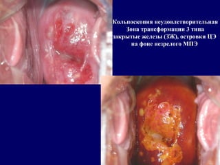 Кольпоскопия неудовлетворительная
Зона трансформации 3 типа
закрытые железы (ЗЖ), островки ЦЭ
на фоне незрелого МПЭ
 