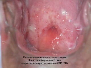 Кольпоскопия неудовлетворительная
Зона трансформации 2 типа
открытые и закрытые железы (ОЖ, ЗЖ)
 