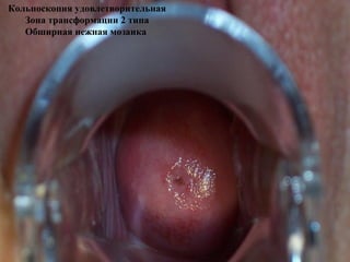 Кольпоскопия удовлетворительная
Зона трансформации 2 типа
Обширная нежная мозаика
 