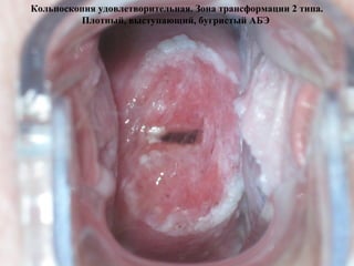 Кольпоскопия удовлетворительная. Зона трансформации 2 типа.
Плотный, выступающий, бугристый АБЭ
 