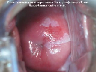 Кольпоскопия неудовлетворительная. Зона трансформации 3 типа.
Белые бляшки - лейкоплакия.
 