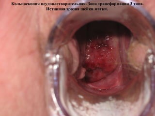 Кольпоскопия неудовлетворительная. Зона трансформации 3 типа.
Истинная эрозия шейки матки.
 