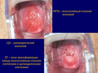 МПЭ – многослойный плоский
эпителий
ЗТ – зона трансформации,
между многослойным плоским
эпителием и цилиндрическим
эпителием
ЦЭ – цилиндрический
эпителий
 