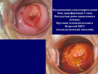 Кольпоскопия удовлетворительная
Зона трансформации 2 типа.
Последствие ранее проведенного
лечения.
Круговая телеангиоэктазия и
Незрелый МПЭ
(метапластический эпителий).
 