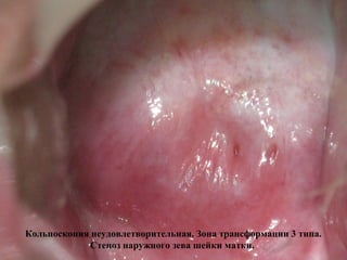 Кольпоскопия неудовлетворительная. Зона трансформации 3 типа.
Стеноз наружного зева шейки матки.
 