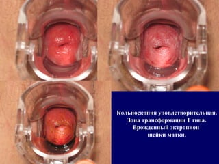 Кольпоскопия удовлетворительная.
Зона трансформации 1 типа.
Врожденный эктропион
шейки матки.
 