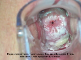 Кольпоскопия удовлетворительная. Зона трансформации 2 типа.
Воспалительный процесс во влагалище.
 