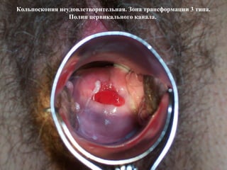 Кольпоскопия неудовлетворительная. Зона трансформации 3 типа.
Полип цервикального канала.
 