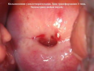 Кольпоскопия удовлетворительная. Зона трансформации 2 типа.
Эндометриоз шейки матки.
 