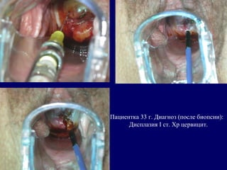 Пациентка 33 г. Диагноз (после биопсии):
Дисплазия I ст. Хр цервицит.
 