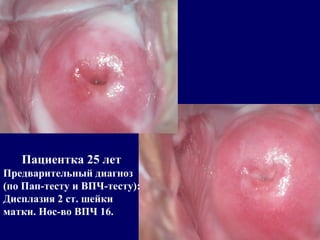 Пациентка 25 лет
Предварительный диагноз
(по Пап-тесту и ВПЧ-тесту):
Дисплазия 2 ст. шейки
матки. Нос-во ВПЧ 16.
 
