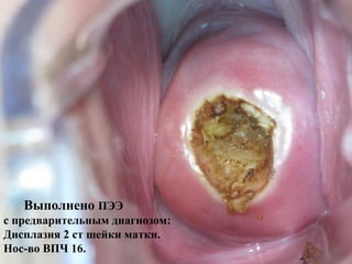 Выполнено ПЭЭ
с предварительным диагнозом:
Дисплазия 2 ст шейки матки.
Нос-во ВПЧ 16.
 