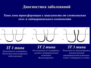 Диагностика заболеванийДиагностика заболеваний
Типы зоны трансформации в зависимости от соотношения
экзо- и эндоцервикального компонента
ЗТ 1 типа
Полностью на экзоцервиксе.
Полностью визуализируется,
любых размеров
ЗТ 2 типа
Не полностью на экзоцервиксе,
имеется эндоцервикальный
компонент.
Визуализируется.
ЗТ 3 типа
Полностью не визуализируется,
имеется большой
эндоцервикальный компонент.
Стык в эндоцервиксе не виден.
 