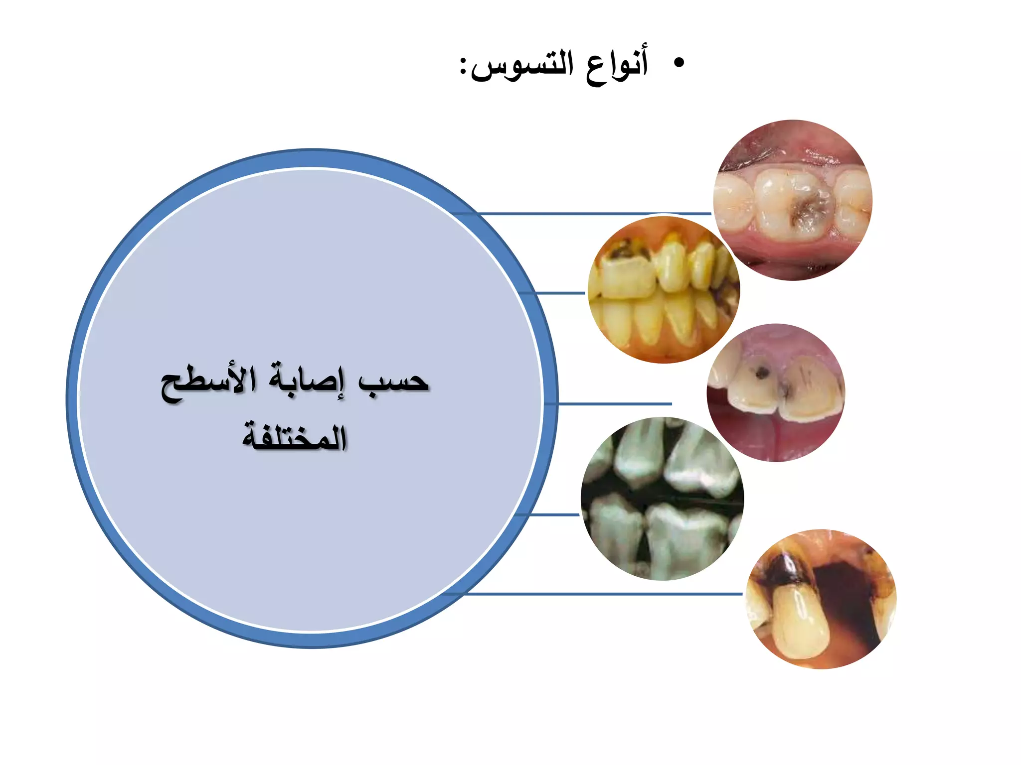 ‫األسطح‬ ‫إصابة‬ ‫حسب‬
‫المختلفة‬
•‫التسوس‬ ‫اع‬‫و‬‫أن‬:
 