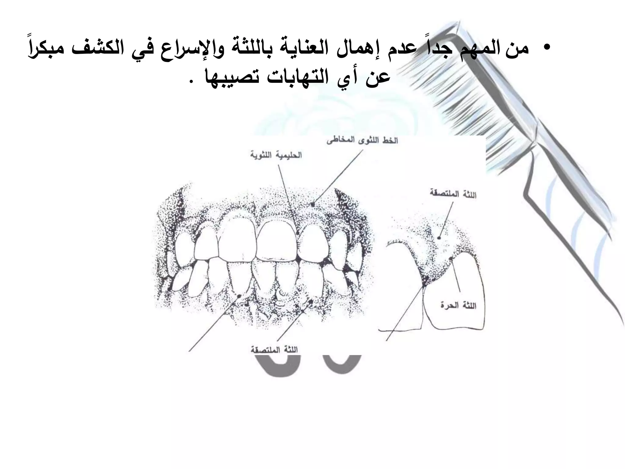 •‫من‬‫الكشف‬ ‫في‬ ‫اع‬‫ر‬‫اإلس‬‫و‬ ‫باللثة‬ ‫العناية‬ ‫إهمال‬ ‫عدم‬ ً‫ا‬‫جد‬ ‫المهم‬ً‫ا‬‫ر‬‫مبك‬
‫تصيبها‬ ‫التهابات‬ ‫أي‬ ‫عن‬.
 
