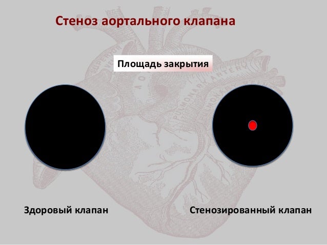 Имплантация аортального клапана