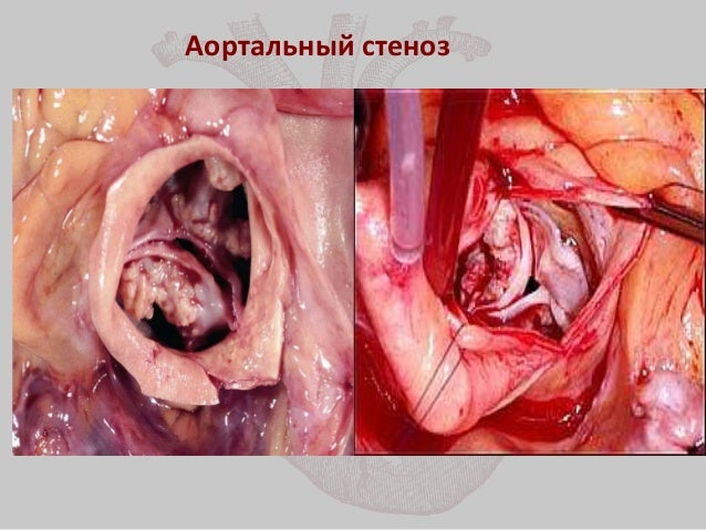 Аортальный Стеноз Презентация