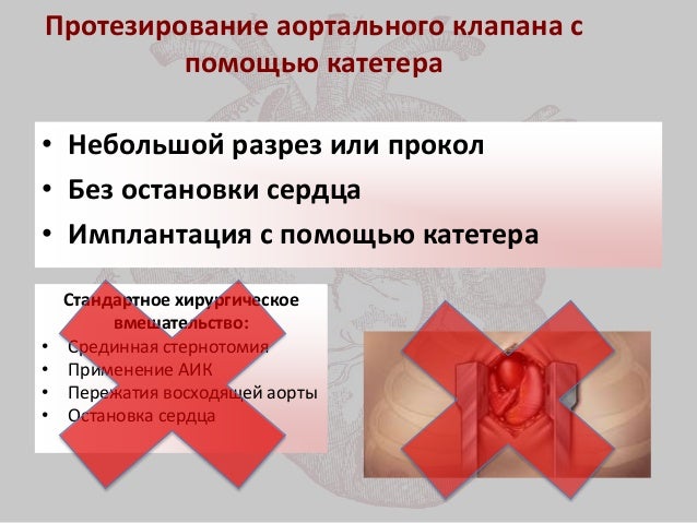 Эндоваскулярное протезирование аортального клапана