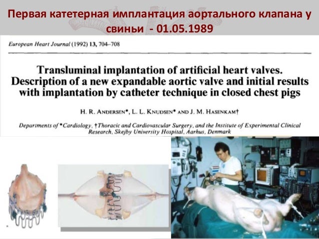 Имплантация аортального клапана