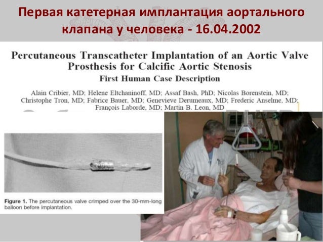 Имплантация аортального клапана
