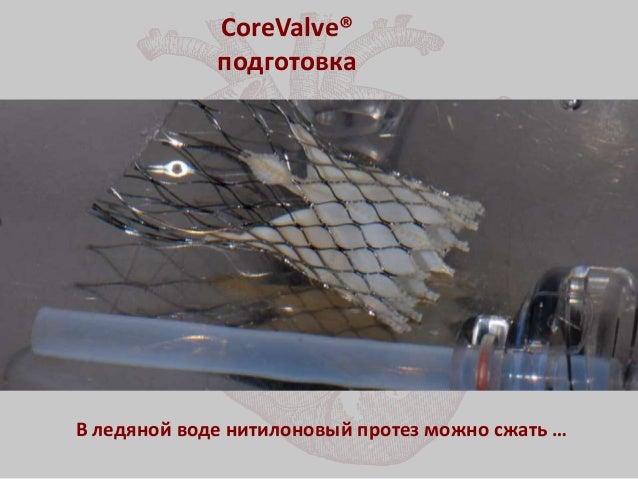 Имплантация аортального клапана