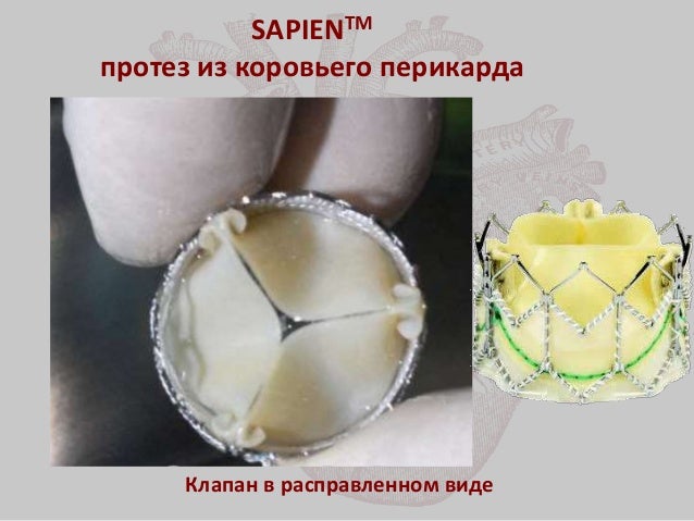 Протез трикуспидального клапана