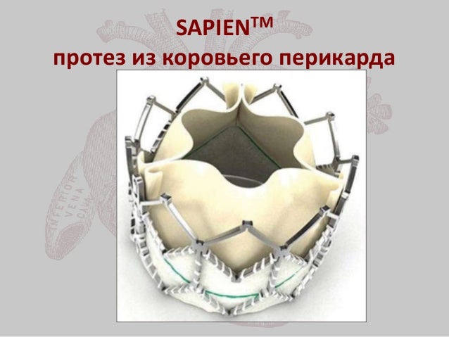 Транскатетерная имплантация аортального клапана Транскатетерная имплантация аортального клапана