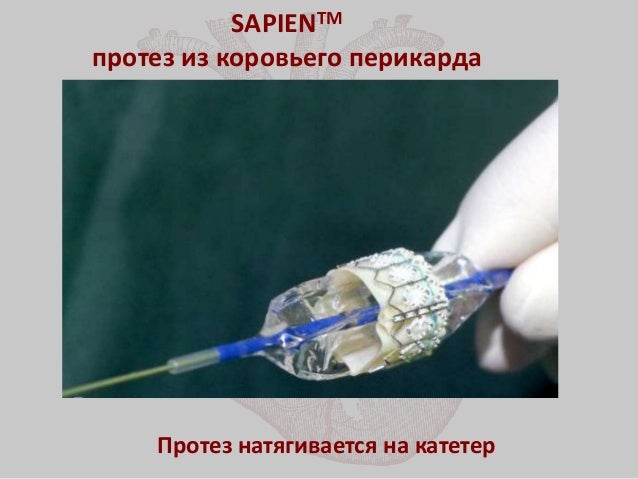 Транскатетерная имплантация аортального клапана Транскатетерная имплантация аортального клапана
