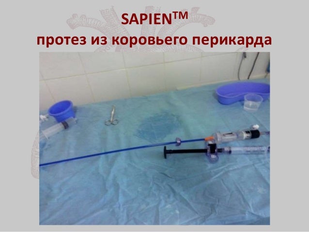 Имплантация аортального клапана