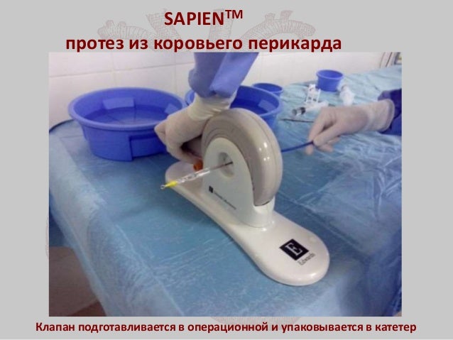 Транскатетерная имплантация митрального клапана Транскатетерная имплантация митрального клапана