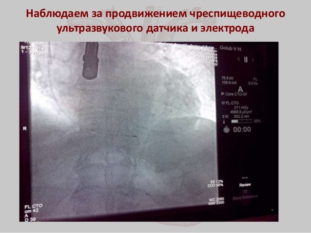 Имплантация аортального клапана