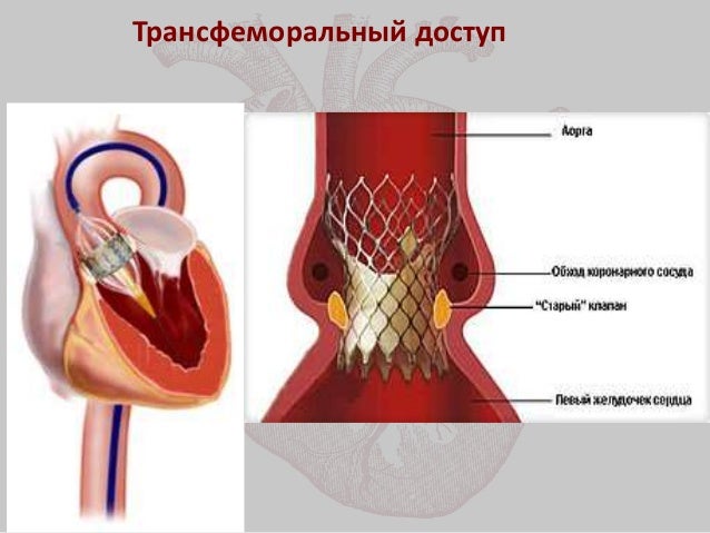 Транскатетерная имплантация аортального клапана Транскатетерная имплантация аортального клапана