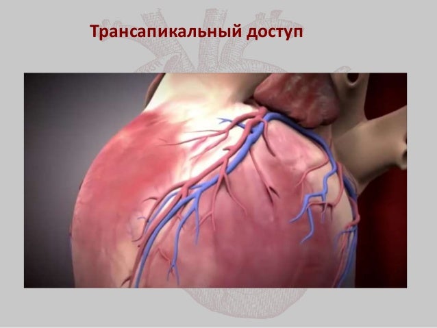 Эндоваскулярное протезирование аортального клапана