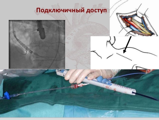 Транскатетерная имплантация аортального клапана Транскатетерная имплантация аортального клапана