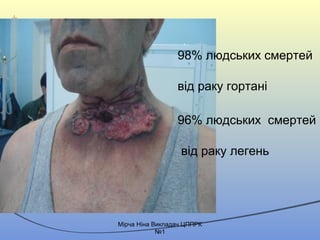 98% людських смертей
від раку гортані
96% людських смертей
від раку легень
Mірча Ніна Викладач ЦППРК
№1
 