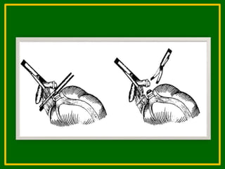 о. аппендицит